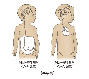  수두증-뇌실-복강단락(V-P션트),뇌실-동맥단락(V-A션트) 그림 예시