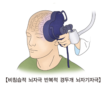 비침습적 뇌자극 반복적 경두개 뇌자기자극