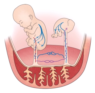 탯줄의 연결된 태아에게 신생아 다혈구증이 발생한 예시