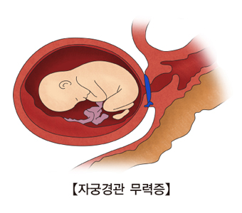 자궁경관무력증-복식 자궁경관 원형결찰술 시행하는 그림 예시