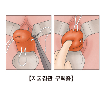 자궁경관무력증-자궁경관 원형결찰술을 시행하는 그림 예시