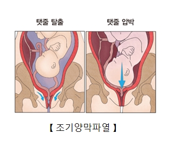 조기양막파열-탯줄탈출된태아와 탯줄압박이된 태아의 그림 예시