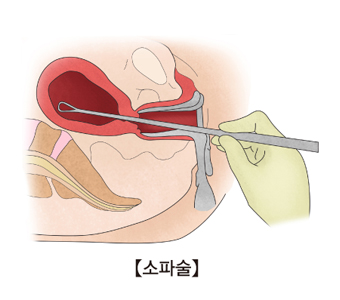 소파술-자궁안의 부산물을 긁어 내고 있음