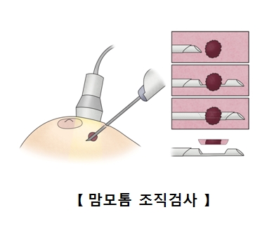 맘모톰 조직검사 그림 예시