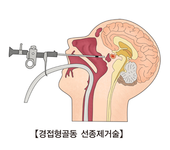 경접형골동 선종제거술 그림 예시