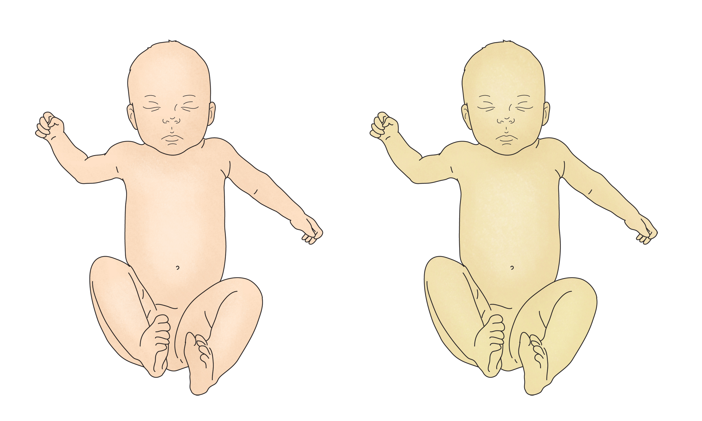 황달이 있는 신생아와 없는 신생아를 비교한 그림