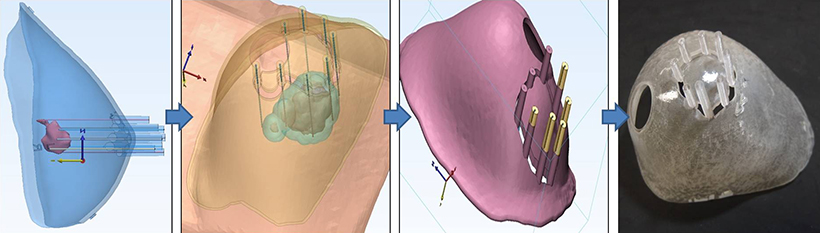 3D 프린터를 활용한 유방 수술 가이드 제작 과정