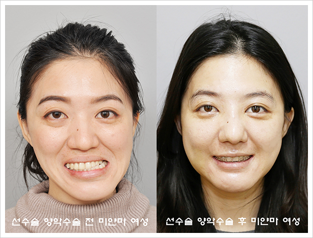 아웅수논씨의 선수술 양악수술 전과 수술 한 달 후 비교 사진