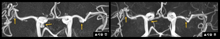 다발성 뇌동맥류 환자 황 모 씨의 시술 전후 자기공명 혈관 조영술(MRA) 영상 비교 사진. 코일색전술 시술 전 보이던 3개의 뇌동맥류(화살표)가 시술 후에는 보이지 않는다.