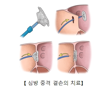  심방 중격 결손의 치료 예시