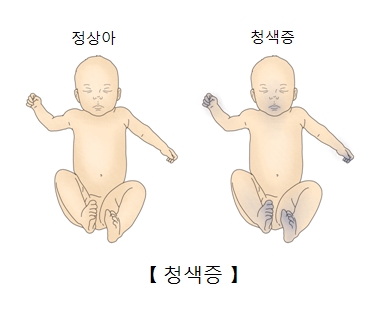 정상아 유아와 청색증 유아 비교 예시