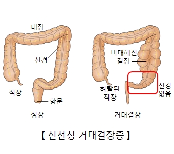 대장 신경 직장 항문등 정상적인모습과 비대해진 결장, 신경없고 허탈된직장 거대결장등 선천성 거대결장증의 예시