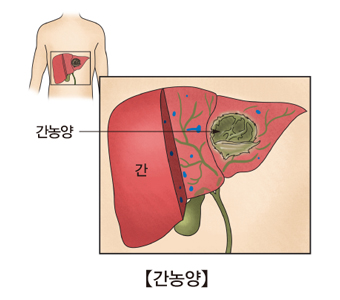 간의모양과 간안에 자리잡고있는 간농양