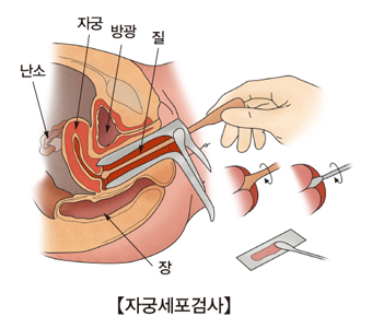 자궁세포검사와 난소 자궁 방광 질의 위치및 자궁세포검사의 예시