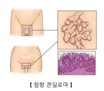 남성과여성의 성기와 인체유두종바이러스