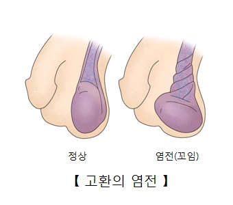 정상적인 고환 및 고환의 염전(꼬임)의 예시