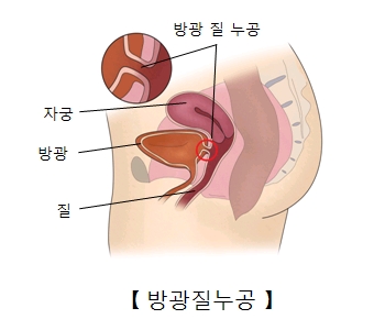 자궁 방광 질 위치 및 방광질 누공의 발생위치 예시