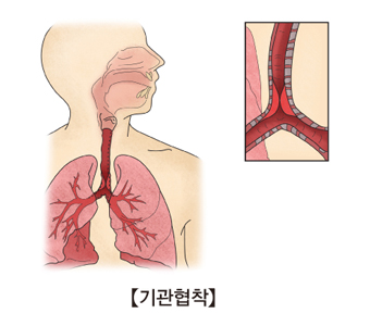 기관협착의 예시