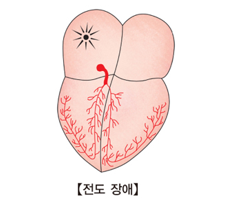 전도 장애의 예시