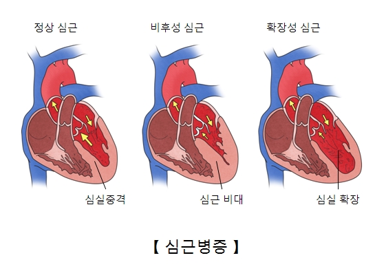 정상심근의 심실중격 비후성심근의 심근비대 확장성심근의 심실확장의 예시및 심근병증의 예