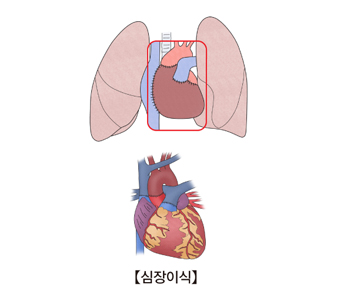 심장이식의 예시