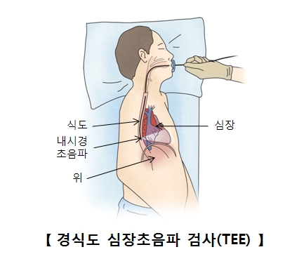 식도 심장 위부분을 내시경 초음파로 경식도 심장초음파 검사를 받고 있는 남성