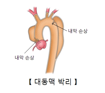 내막이 손상된 대동맥 박리