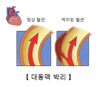 정상혈관과 박리된 혈관의 차이