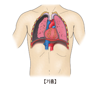 공기가슴증의 예시