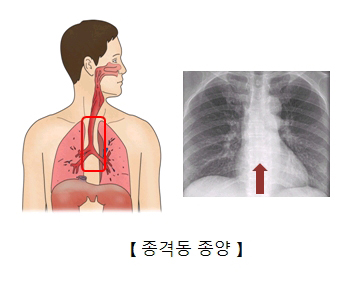 종경동 종양 x-ray 이미지