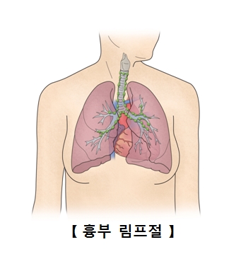 흉부 림프절의 예시