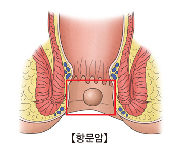 항문암의 예시