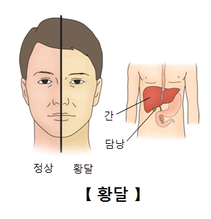 정상상태와 활달상태 비교 예시 및 간 과 담낭의 위치