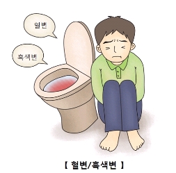 혈변 및 흑색변으로 고통스러워 하는 남성