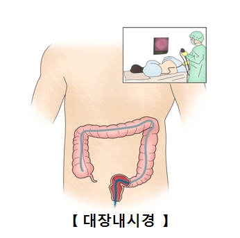 대장내시경 하는 모습 예시