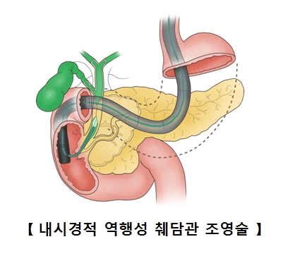 내시경적 역행성 췌담관 조영술 예시