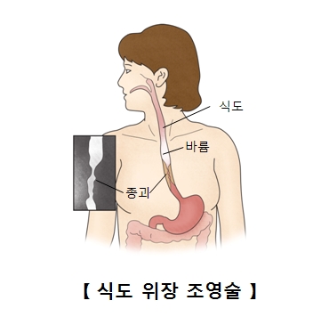 식도 바륨 종괴등 위치 크기 모양등을 알아보는 식도 위장 조영술을 받고 있는 여성