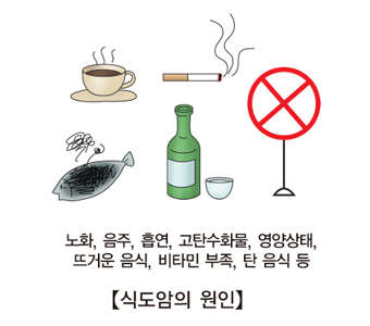 노화 음주 흡연 고탄수화물 영양상태 뜨거운음식 비타민부족 탄음식등 식도암의 원인 예시