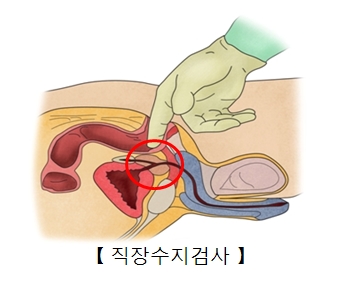 항문에 손가락을 집어넣어 하는 검사인 직장수지검사의 예시