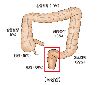 황행결장(10%) 하행결장(3%) 에스결장(29%) 직장(38%) 맹장(15%) 상행결장(5%)등 대장암이 발생하는 부위의 예시