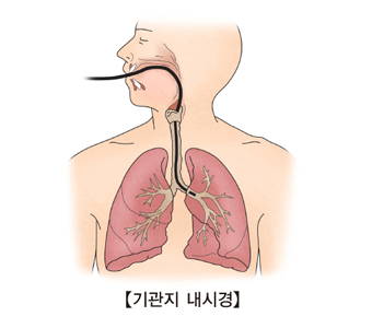 기관지 내시경의 예시