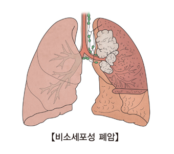 비소세포성 폐암예시