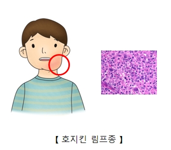 호지킨 림프종으로 턱주위가 부어오른 남자아이 및 호지킨 림프종 세포의 예시