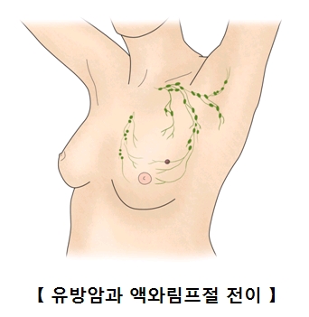 유방암과 액와림프절 전이의 예시