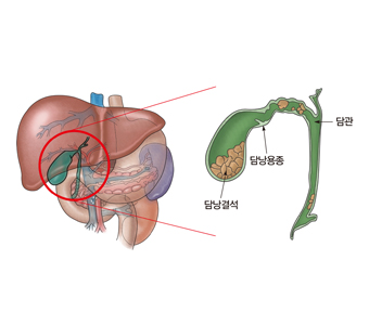 간문부 담관에 생기는 담관암및 담관 담낭용종 담낭결석등 담낭의구조 예시