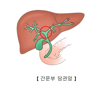 간문부 담관암 예시