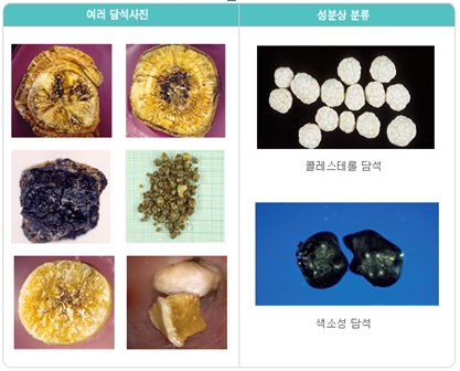 여러 담석사진 및 성분상 분류된 코레스테롤 담석 및 색소성 담석의 예시