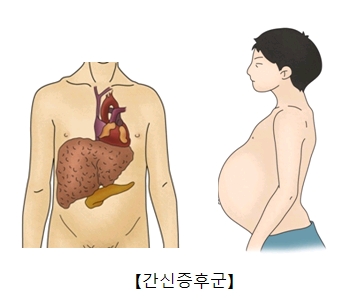 간신 증후군에 걸린 남성의 예시