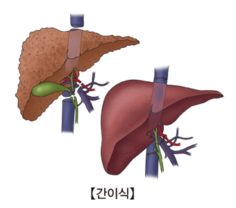  간이식의 예시