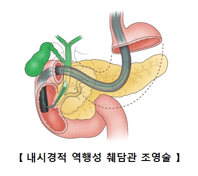 내시경적 역행성 췌담관 조영술